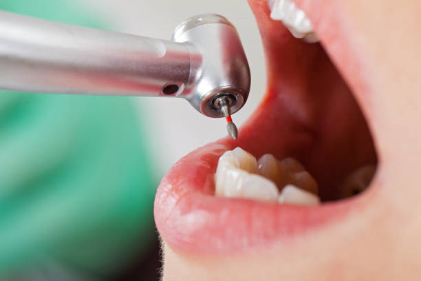 Best Emergency Root Canal Treatment in Dunn, NC